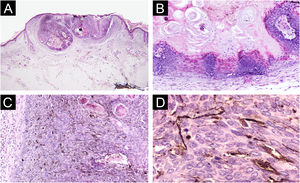 Achados histopatológicos. (A) Tumor lobulado bem circunscrito. Hematoxilina & eosina, 4×. (B) Células basaloides, células fantasmas e queratinização compacta. Hematoxilina & eosina, 10×. (C) Células basaloides e numerosos melanócitos dendríticos. Hematoxilina & eosina, 20×. (D) Melanócitos dendríticos pigmentados. Hematoxilina & eosina, 40×.