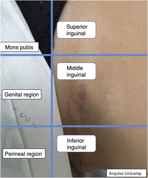 Região inguinal.