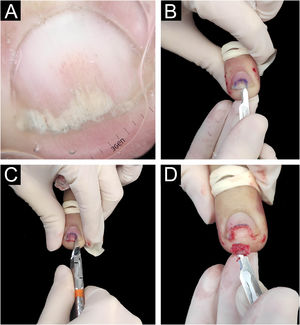 Técnica de biopsia tangencial longitudinal. (A) Onicoscopia: onicólise regular com mancha salmão e vasos lineares dilatados. (B) Descolamento parcial da lâmina ungueal com lâmina de bisturi número 15, na região demarcada. (C) Corte parcial da lâmina com alicate. (D) Biopsia tangencial ligeiramente mais espessa do leito ungueal (amostra medindo 0,7×0,2×0,1 cm).