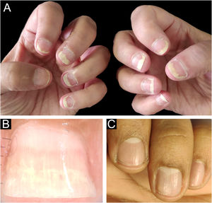 Psoríase ungueal. (A) Onicólise regular com mancha salmão em vários dedos. (B) Onicoscopia: onicólise regular com mancha salmão. (C) Pittings ungueais grosseiros.