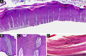 Psoríase (leito ungueal). (A) Hiperplasia psoriasiforme da epiderme, derme papilar hipervascularizada e adelgaçamento do estrato espinhoso suprapapilar. (B‐C) Adelgaçamento do estrato espinhoso suprapapilar, papilas altamente vascularizadas e ausência de espongiose. (D) Paraceratose e exsudato de neutrófilos intracorneanos. Hematoxilina & eosina, 40×(A) e 400×(B‐D).