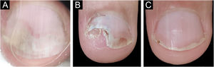 Psoríase ungueal – antes e depois da biopsia tangencial. (A) Onicoscopia da área a ser biopsiada – onicólise regular com manchas salmão e hemorragias em estilhaços. (B) Pós‐operatório de sete dias – excelente cicatrização do leito. (C) Pós‐operatório de 30 dias – recuperação completa da unha.