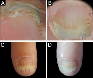 Psoríase ungueal – antes e depois da biopsia tangencial. (A‐B) Onicoscopia da área a ser biopsiada – onicólise regular com mancha de óleo, hemorragias em estilhaços e hiperceratose subungueal compacta. (C) Período pós‐operatório imediato. (D) Pós‐operatório de 30 dias – recuperação completa da unha.