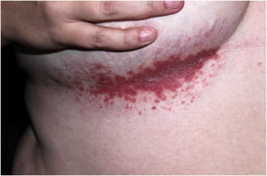 Placa eritematosa macerada com erosões lineares na região inframamária.