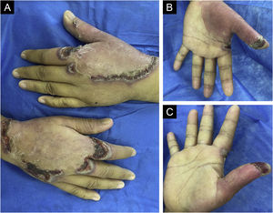 (A) Placas simétricas na superfície dorsal das mãos com halo bolhoso periférico, crostas e borda eritematosa arroxeada. (B‐C) Eritema palmar com lesões bolhosas arroxeadas nos polegares.