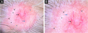 Dermatoscopia da lesão da região frontal. Áreas vermelho‐leitosas, vasos arboriformes (setas pretas), telangiectasias finas (setas azuis), áreas brancas brilhantes (asteriscos pretos), pontos amarelos (pontas de seta), áreas alaranjadas mal delimitadas (asteriscos azuis). Luz polarizada com contato e fluido de imersão (10×).