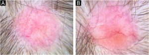 Dermatoscopia das lesões da região parietal direita (A) e do vértice (B). Padrão dermatoscópico semelhante ao encontrado na região frontal (figs. 2 e 3). Luz polarizada sem contato (10×).