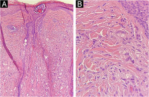 Histopatologia da metástase alopécica da região frontal. (A) Infiltrado difuso de células neoplásicas na derme. Presença de um folículo piloso com dilatação infundibular. (B) Detalhe do infiltrado neoplásico: células epitelioides atípicas, isoladas ou em pequenos agrupamentos rodeando lúmens glandulares. Hematoxilina & eosina, 100×(A) e 400×(B).