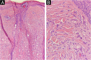 Histopatologia da metástase alopécica da região frontal. (A) Infiltrado difuso de células neoplásicas na derme. Presença de um folículo piloso com dilatação infundibular. (B) Detalhe do infiltrado neoplásico: células epitelioides atípicas, isoladas ou em pequenos agrupamentos rodeando lúmens glandulares. Hematoxilina & eosina, 100×(A) e 400×(B).