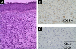 (A) Extensa infiltração por macrófagos com citoplasma de aspecto espumoso (Hematoxilina & eosina, 20×). (B) Células xantomizadas CD68+ (imuno‐histoquímica, 10×). (C) Células xantomizadas S100−, CD1a− (imuno‐histoquímica, 10×).