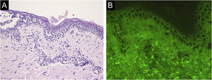 (A) Achados histopatológicos mostrando acantólise nas camadas epidérmicas inferiores e presença de denso infiltrado dérmico de linfócitos e eosinófilos (40×). (B) Imunofluorescência direta revelou deposição intercelular de IgG na porção inferior da epiderme (40×).