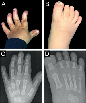 Imagens clínicas com onicodistrofia (A‐B) e radiográficas (C‐D) mostrando hipoplasia das falanges distais do 2°, 3°, 4° e 5° quirodáctilos, ausência de falanges distais no 2°, 3°, 4° e 5° pododáctilos e hipoplasia da falange distal do 1° pododáctilo.