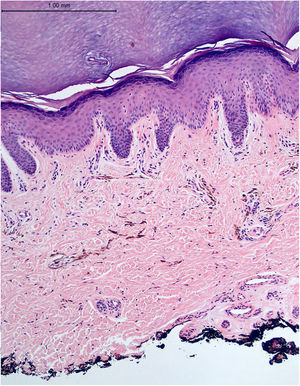 Pele acral ‐ células dendríticas pigmentadas esparsas na derme reticular (Hematoxilina & eosina, 100×).