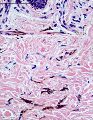 Derme reticular com proliferação de células dendríticas pigmentadas no meio de fibras colágenas preservadas (Hematoxilina & eosina, 400×).