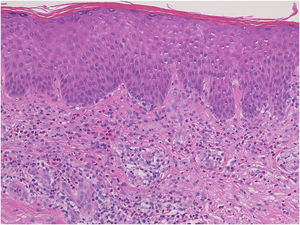 Histopatologia mostrando degeneração vacuolar da camada basal da epiderme e infiltração por células mononucleares e eosinófilos na derme superior.