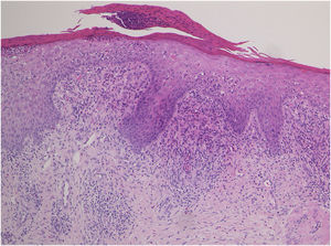 Histopatologia mostrando microabcesso subcórneo, proliferação epidérmica, queratinização celular individual dispersa e degeneração por liquefação na camada basal da epiderme.