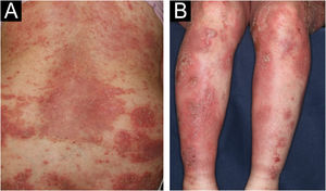 (A‐B) Múltiplas áreas eritematosas e pequenas pústulas com escamas no tronco e extremidades, e edema proeminente em ambas as pernas.