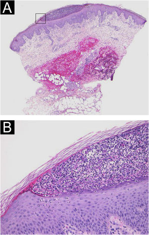 (A) Pústulas subcórneas na histopatologia (Hematoxilina & eosina, 20×). (B) Acúmulo subcórneo de neutrófilos circundados por pequenas pústulas multiloculares com espongiose (pústula espongiforme de Kogoj, 200×).
