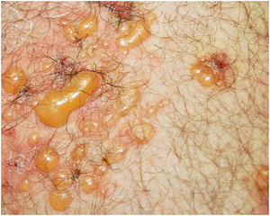 Bolhas tensas com base eritematosa.
