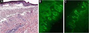 Histopatologia de lesão bolhosa. (A) Bolha subepidérmica contendo eosinófílos (Hematoxilina & eosina). (B) Deposição linear de C3 na membrana basal (imunofluorescência direta). (C) Deposição linear de IgG na membrana basal (imunofluorescência direta).