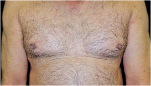 Resolução completa das placas de psoríase (PASI0) e nenhuma nova lesão bolhosa de penfigoide após dois meses de tratamento com guselcumabe.