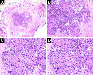 Achados histológicos. (A) Nódulo tumoral bem demarcado por pseudocápsula fibrosa (Hematoxilina & eosina, 40×). (B) Proliferação de células arredondadas com citoplasma eosinofílico envoltas em estroma anfofílico que circunda vasos ramificados (Hematoxilina & eosina, 100×). (C) Proliferação de células arredondadas com citoplasma eosinofílico (Hematoxilina & eosina, 200×). (D) Estroma anfofílico circundando vasos ramificados (Hematoxilina & eosina, 200×).