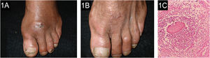 (A) Paciente 1: micetoma por Fusarium chlamydosporum, antes do tratamento. (B) Ao final do tratamento de 18 meses. (C) Microabscesso com grânulo na histopatologia (Hematoxilina & eosina, 10×).
