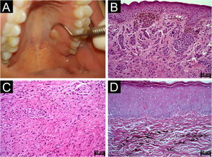 Nevos intramucosos e azuis. (A) Edema nodular coberto por mucosa íntegra na região esquerda do palato correspondendo a nevo melanocítico intramucoso. (B) Ninhos de células névicas pigmentadas separadas do revestimento epitelial por membrana basal evidente. Observar células poligonais e epitelioides na região subepitelial e as células profundas semelhantes a linfócitos (Hematoxilina & eosina, barra de escala: 50μ). C, Nevo azul mostrando células fusiformes anguladas, profundamente assentadas com neurotização, tipo C (Hematoxilina & eosina, barra de escala: 50μ). D, Nevo azul composto por células fusiformes e dendríticas contendo pigmento melanina acastanhado (Hematoxilina & eosina, barra de escala: 50μ).