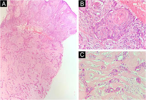 Histopatologia. (A) Corte histológico evidenciando tumor com crescimento infiltrativo invadindo a derme profunda (Hematoxilina & eosina, 4×). (B) Diferenciação escamosa nas porções mais superficiais (Hematoxilina & eosina, 20×). (C) Diferenciação ductal écrina na profundidade do tumor (Hematoxilina & eosina, 10×).