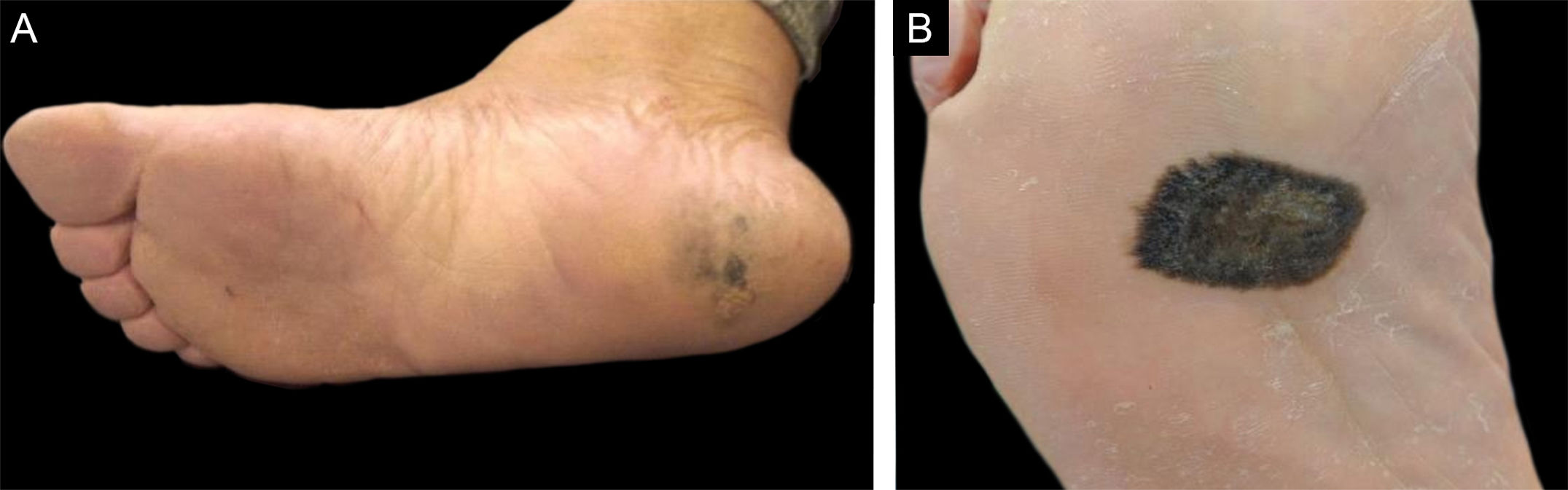 Melanoma Acral Plantar Perfil Epidemiol gico Cl nico Dermatosc pico melanoma-acral-plantar-perfil-epidemiol-gico-cl-nico-dermatosc-pico