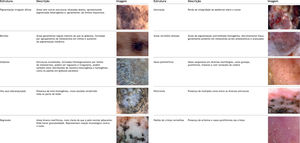 Estruturas dermatoscópicas descritas nos melanomas acrais.