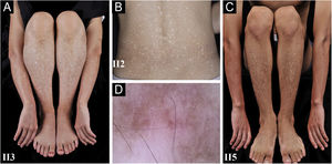 Observação clínica e dermatoscópica. (A‐C) Hiperpigmentação difusa mesclada com numerosas máculas hipopigmentadas nos membros e região dorsal em três pacientes com ACD, sem comprometimento do dorso das mãos e pés. (D) A dermatoscopia apresentava máculas brancas, irregulares, mal definidas, circundadas por pigmentação acastanhada e vasos lineares indistintos (ampliação original 60×).