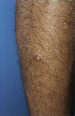 Pápula normocrômica, de superfície lisa e regular, consistência fibroelástica, localizada na face anterolateral da perna direita.