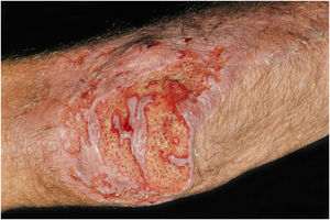 Criptococose cutânea primária: lesão ulcerada, fundo limpo, com pontilhados hemorrágicos, ilhas de tecido íntegro e bordas infiltradas. Foto pós desbridamento. Cotovelo. Paciente do sexo masculino, 74 anos. Corticoterapia 10mg/dia, irregular, DPOC. Lesão pós‐trauma quando de limpeza de sótão de igreja Católica.