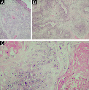 (A) Exame histopatológico da biopsia cutânea do carcinoma sebáceo da região mandibular esquerda (Hematoxilina & eosina, 10×). (B) O exame histológico revelou a presença de invasão desordenada da derme por lóbulos mal definidos de sebócitos atípicos (Hematoxilina & eosina, 100×). (C) Em maior aumento, pode ser observado sebócitos atipicos (Hematoxilina & eosina, 400×).