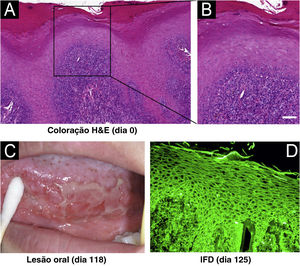 Características clínicas e histopatológicas da paciente. (A e B) Histopatologia de biopsia da mancha branca da margem direita da língua (coloração de Hematoxilina & eosina, barra=50μm). (C) Lesões orais. (D) Imunofluorescência direta (IFD) mostrou imunomarcação intercelular com IgG.