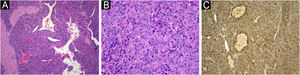 (A) Na histopatologia, em pequeno aumento, a neoplasia consiste em células redondas ao redor de espaços vasculares (Hematoxilina & eosina, 40×). (B) Em maior aumento as células glômicas são atípicas com núcleos pleomórficos e nucléolos proeminentes. Numerosas mitoses estão presentes (Hematoxilina & eosina, 200×). (C) As células tumorais são positivas para actina (Actina anti‐músculo liso, 100×).