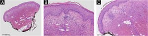 Histopatologia da pele mostrando hiperceratose e acantose de pequeno grau. A derme mostra infiltrado inflamatório moderado de leucócitos linfoplasmocitários, e hemorragia tecidual extensa. Não há evidência de vasculite nem de edema na derme papilar. (A) Histopatologia da pele em pequeno aumento demonstrando hiperceratose, inflamação de pequeno grau e hemorragia. (B) Hiperceratose e acantose de pequeno grau. (C) Infiltrado inflamatório moderado com acentuação perivascular e hemorragia tecidual na derme profunda e hipoderme. Coloração de Hematoxilina & eosina.