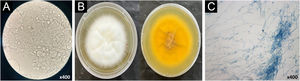 Exames micológicos de Trichophyton indotineae. (A) Exame microscópico direto (com 10% de KOH) em microscopia de luz (400×) evidenciando hifas septadas hialinas ramificadas e artroconídios. (B) Macromorfologia de cultura de fungos em meio Sabouraud de anverso branco aveludado e reverso com pigmento amarelo claro. (C) Micromorfologia em microscopia de luz (400×), corada com azul de lactofenol, evidenciando presença de numerosos microconídios piriformes e clavados e macroconídios septados em forma de fuso.