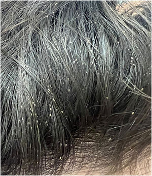 Pediculose (lêndeas), a afecção mais diagnosticada nos abrigos.