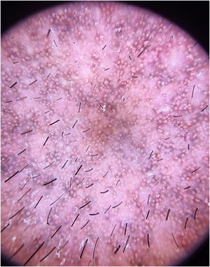 Dermatoscopia. Hiperpigmentação marrom‐acinzentada com padrão liquenoide ao redor de aberturas foliculares e estruturas isoladas, brancas e brilhantes, semelhantes a rosetas.