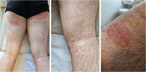 Aspecto clínico das lesões de dermatofitose causada por Trichophyton indotineae acometendo região posterior de membros inferiores.