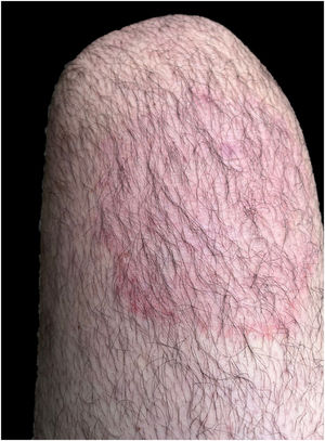 Aspecto clínico da recidiva da dermatofitose causada por Trichophyton indotineae acometendo face anterior da coxa direita.