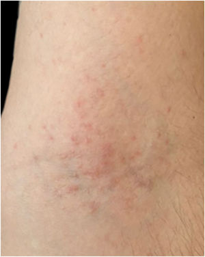 Dermatite irritativa após contato com água das inundações.