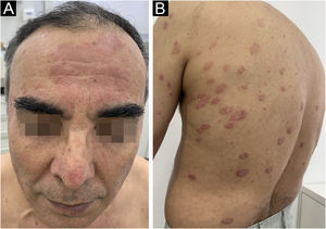 Placas eritematosas e descamativas na fronte (A) e na região dorsal (B).