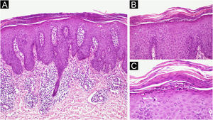 (A) Acantose regular, hipogranulose, paraceratose, capilares dilatados na derme papilar (Hematoxilina & eosina, 100×). (B) Paraceratose e microabscessos de Munro (Hematoxilina & eosina, 200×). (C) Maior aumento mostrando paraceratose e microabscessos de Munro (Hematoxilina & eosina, 400×).
