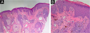 Histopatologia da pele exibindo características consistentes com dermatite liquenoide pigmentada. (A) Epiderme hiperceratótica com acantose irregular, e com infiltrado linfoplasmocitário perivascular e perifolicular na derme, acompanhado de numerosos melanófagos (Hematoxilina & eosina, 100×). (B) Corpúsculos de Civatte também estão presentes (Hematoxilina & eosina, 200×).