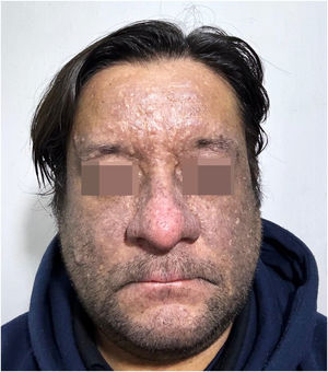 Hiperpigmentação facial após a descontinuação do golimumabe e quatro meses de terapia com adalimumabe, mostrando alguma redução.