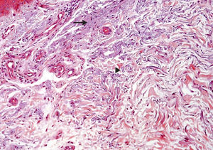 Caracterização histopatológica dos aspectos dérmicos encontrados na pele fotoexposta de transplantado renal do grupo imTOR. A elastose solar é caracterizada por áreas basofílicas amorfas (seta) e fibrilares (cabeça da seta) do tecido conjuntivo dérmico, onde as fibras elásticas perdem suas características usuais (Hematoxilina & eosina, 200×). imTOR, grupo inibidores de mTOR.
