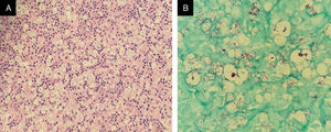 Biopsia de linfonodo inguinal. (A) Presença de infiltrado histiocítico difuso, com desorganização do estroma linfonodal e presença de linfócitos típicos (Hematoxilina & eosina, 40×). (B) Presença de inúmeros bacilos álcool‐ácido resistentes, organizados em globias dentro de histiócitos xantomatosos (Fite‐Faraco, 100×).